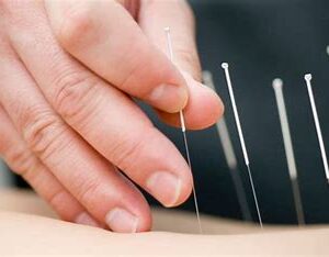 針灸治療